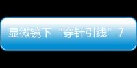 显微镜下“穿针引线”7小时！金湾这家医院成功帮患者保住断肢